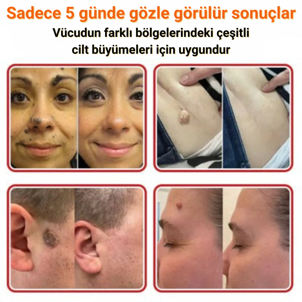 Ryles Mikro İğneli Ben Bandı 5 Günde Acısız Son!