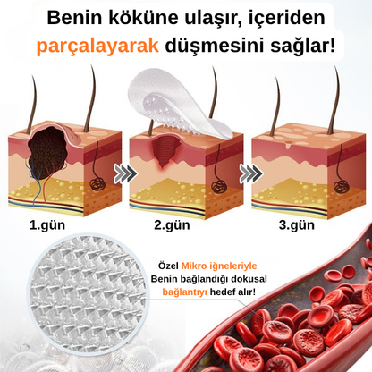 Ryles Mikro İğneli Ben Bandı 5 Günde Acısız Son!