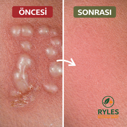 Ryles Mikro İğneli Siğil Bandı 5 Günde Acısız Son!