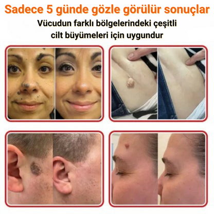 Ryles Mikro İğneli Ben Bandı 5 Günde Acısız Son!